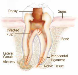 molar abscess