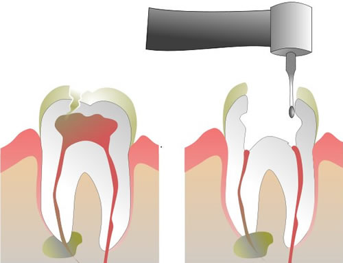 Root Canal Procedure Step 1 and 2