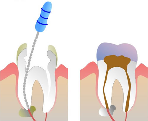 Root Canal Procedue part 3 and 4